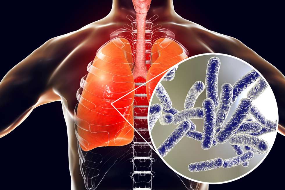 Efectos en el organismo de la legionella